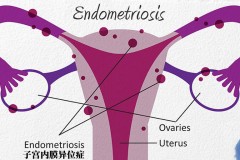 盆腔炎和子宫内膜异位症的比较