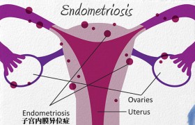盆腔炎和子宫内膜异位症的比较