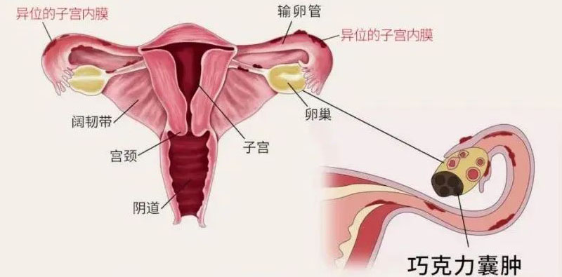 子宫内膜异位症是怎么造成的可以治愈吗能怀孕吗