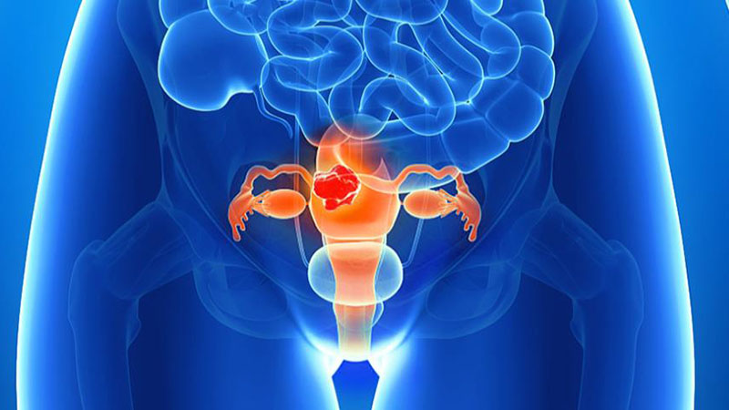 子宫肌瘤有可能导致什么癌变吗