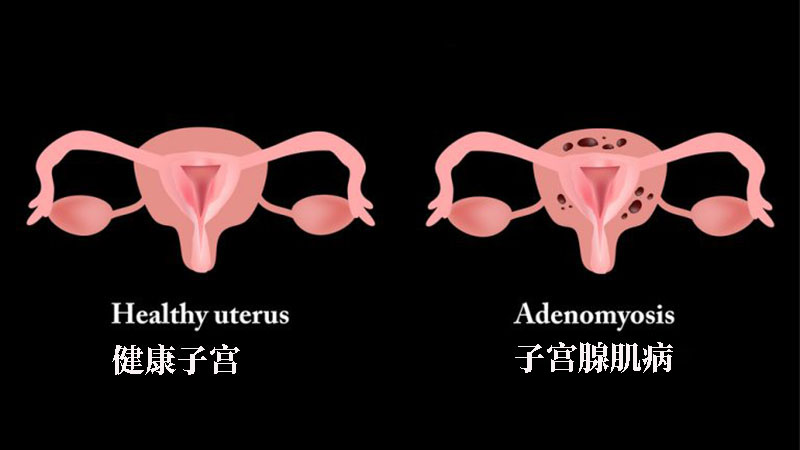 子宫腺肌症国外有何好的治疗方案吗多少钱一次