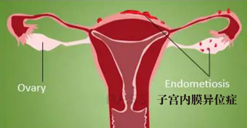 子宫内膜异位症主要发生在什么部位器官有什么表现?