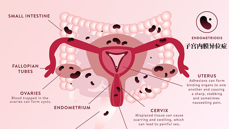 子宫内膜异位症造成卵巢巧克力囊肿是不是很难怀孕很严重