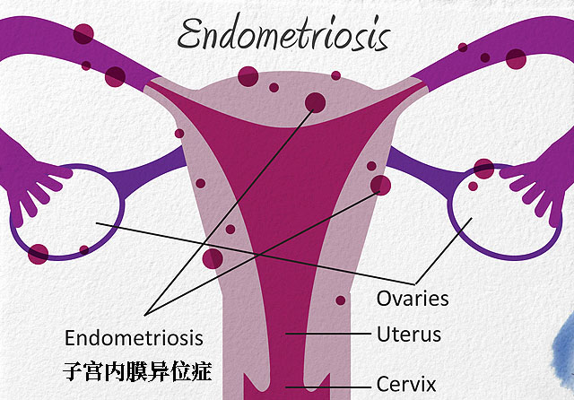 子宫内膜异位症为什么不容易怀孕的原因有哪些