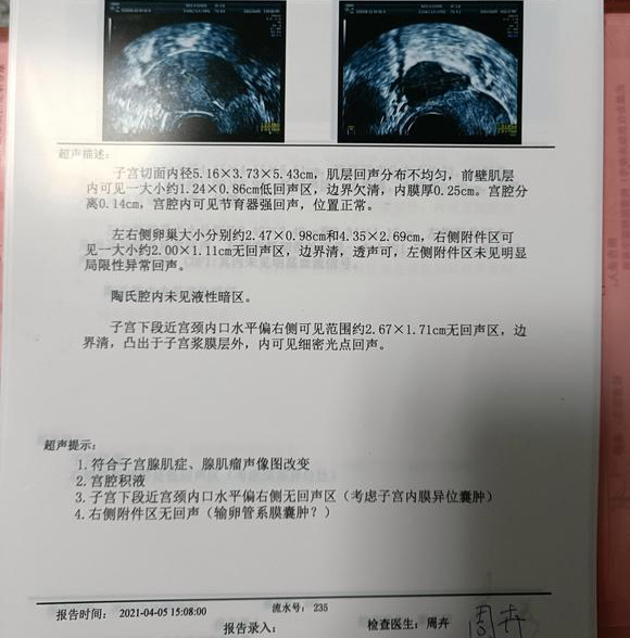 子宫肌瘤和子宫内膜异位症怀孕后会复发吗女性