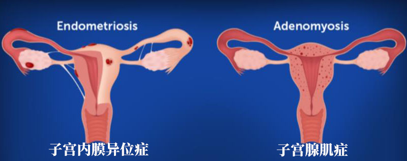 子宫腺肌症引起的月经量多时间长怎么办吃什么药