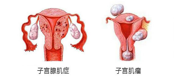 子宫腺肌症月经出血十三天来血块怎么办呢吃什么药