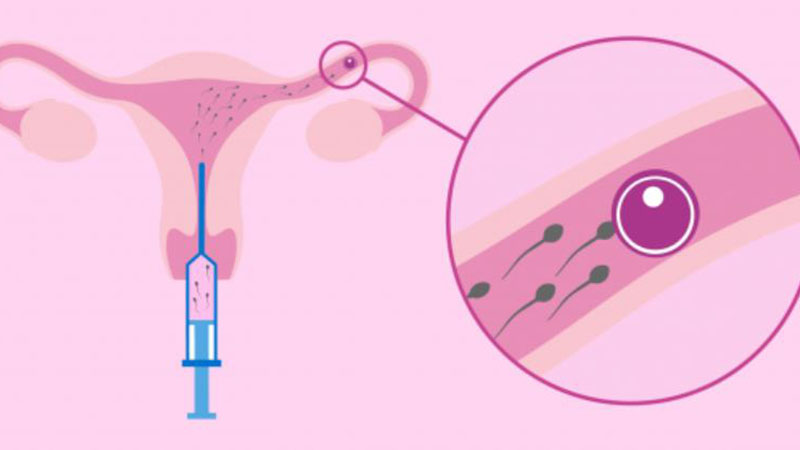 子宫内膜异位症导致流产怎么治疗最好的方法是什么