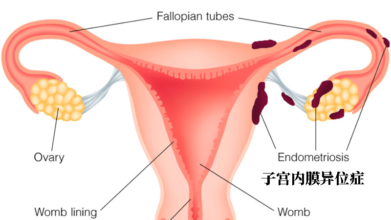 子宫内膜异位症烦躁易怒怎么办吃什么药调理好