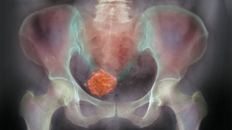 子宫肌瘤来月经周期时间长量很多怎么办