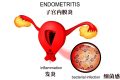 子宫内膜异位症导致的不孕怎么治疗能治好吗