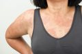甲状腺疾病会引起荨麻疹皮肤疾病吗怎么治疗