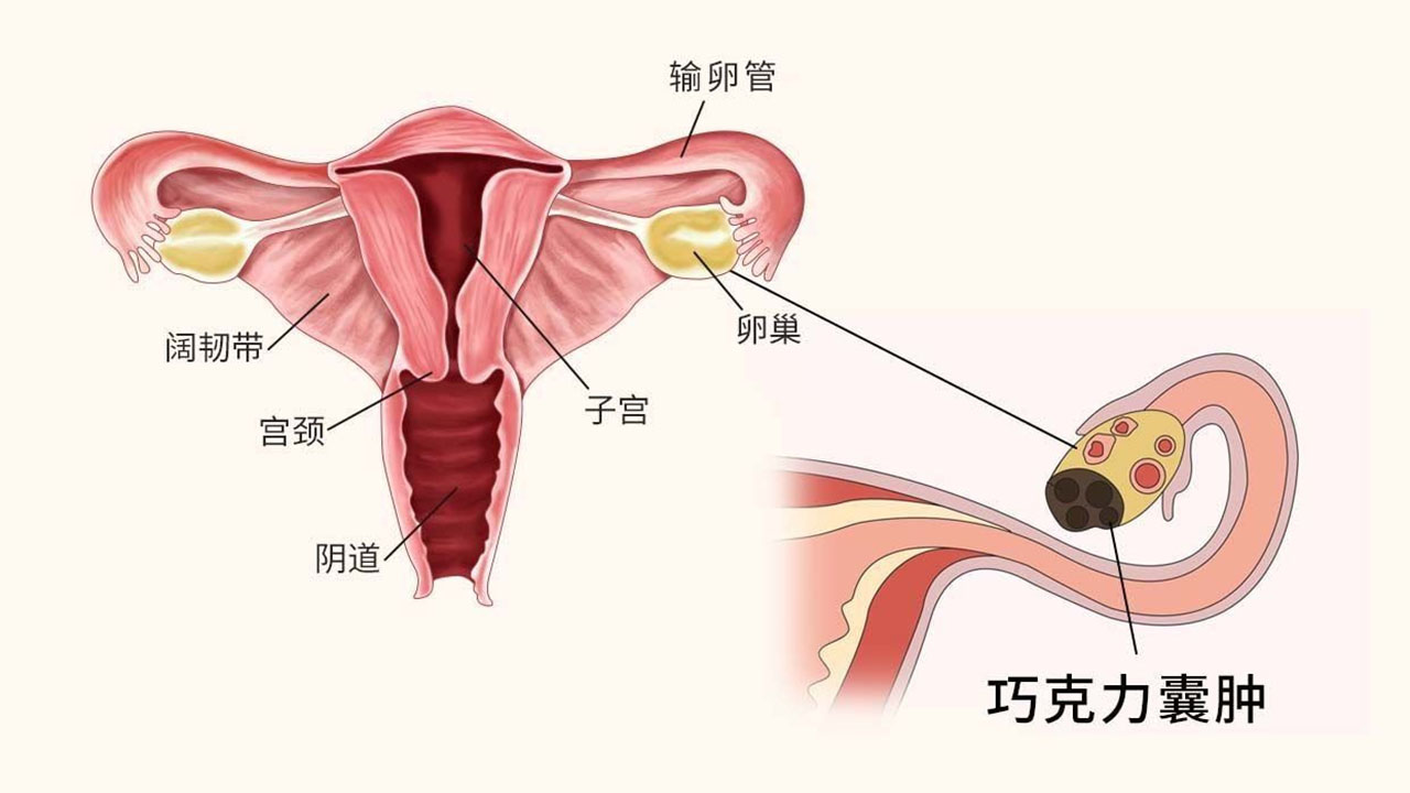 巧克力囊肿不生孩子可以不治疗吗女性