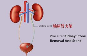 输尿管支架置入术后腰疼的厉害是啥原因