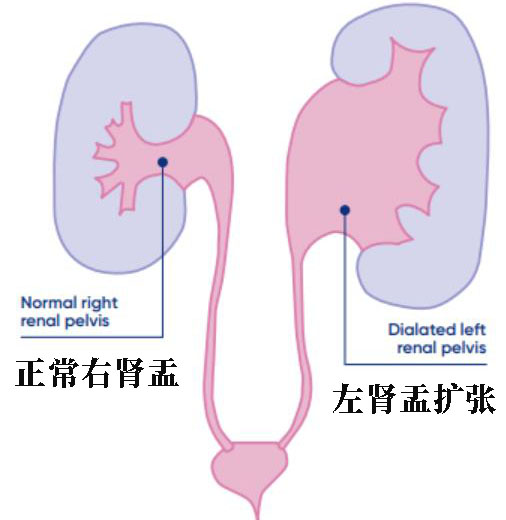 肾输尿管结石疼的时候是不是在往外出排